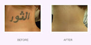 Abington Aesthetic & Laser Medical Center: Dr. Evan Zelinger D.o. Laser Tattoo Removal