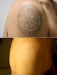 Allergy & Skin Spa Laser Tattoo Removal