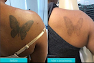 Arviv Medical Aesthetics Tampa Laser Tattoo Removal