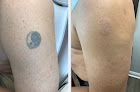 Avail Aesthetics - Cary Laser Tattoo Removal