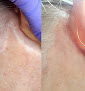 Avandra Spa Laser Tattoo Removal