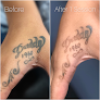 Bad Habits Tattoos & Laser Tattoo Removal Laser Tattoo Removal