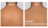Bare Ny Laser Hair Removal & Aesthetics | New York's #1 Laser Hair Removal Spa Laser Tattoo Removal