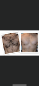 Bare Skin Studio Laser Tattoo Removal