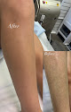 Beauty Laser Studio Laser Tattoo Removal