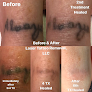 Before & After Laser Tattoo Removal Laser Tattoo Removal
