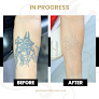 Bh Laser Tattoo Removal Laser Tattoo Removal