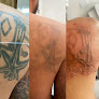 Bio-Skin Med|Aesthetics Laser Tattoo Removal