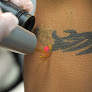 Body Details Laser Tattoo Removal