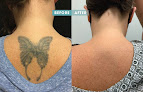 Bonsai Laser Tattoo Removal Laser Tattoo Removal