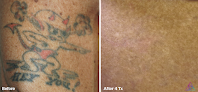 Bonsai Laser Tattoo Removal Laser Tattoo Removal
