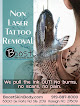 Boost Skin And Body Laser Tattoo Removal