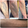 Bye Bye Ink Laser Tattoo Removal Laser Tattoo Removal