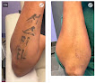 Calista Skin And Laser Center Laser Tattoo Removal