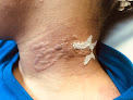 Cirius Hair And Laser Laser Tattoo Removal