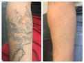 Clean Canvas Laser Laser Tattoo Removal