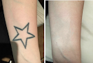 Clean Slate Ink - Tattoo Removal In Round Rock, Tx Laser Tattoo Removal