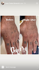 Clear Out Ink Laser Tattoo Removal Laser Tattoo Removal