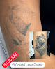Coastal Laser Center Laser Tattoo Removal
