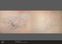 Coral Springs Med Spa Laser Tattoo Removal