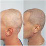 Cosmetic Aesthetics Laser Tattoo Removal