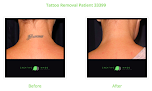 Creative Image Laser Solutions Laser Tattoo Removal