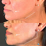 Deja Vu Med Spa Laser Tattoo Removal