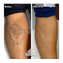Deleted Scene Tattoo Removal Laser Tattoo Removal