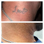 Denton Laser Tattoo Removal Laser Tattoo Removal