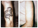 Dfw Tattoo Removal Laser Tattoo Removal