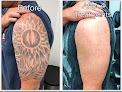 Dr. Removal Laser Tattoo Removal