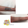 East Coast Laser Tattoo Removal Laser Tattoo Removal