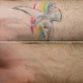 Electrolysis And Laser Center Laser Tattoo Removal