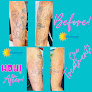 Envision Laser Removal Laser Tattoo Removal