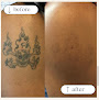 Eos Tattoo Removal Laser Tattoo Removal
