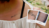 Eraditatt Tattoo Removal Of Palm Harbor/Clearwater Laser Tattoo Removal