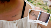 Eraditatt Tattoo Removal Of St. Petersburg Laser Tattoo Removal