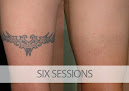 Eraditatt Tattoo Removal Of Tampa Laser Tattoo Removal