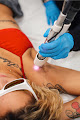 Erase Spa Laser Tattoo Removal