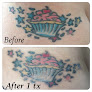 Erie Laser Professionals Laser Tattoo Removal