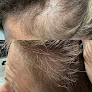 Estetique Solutions Laser Tattoo Removal