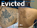 Evicted Ink Laser Tattoo Removal Laser Tattoo Removal