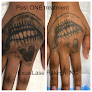 Excellase Laser Tattoo Removal