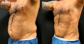 Finesse Cosmetic Surgery Laser Tattoo Removal