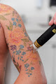 Flawless Reflections Body And Skin Therapy Flawless Reflections Medspa Laser Tattoo Removal