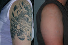 Gateway Aesthetic Institute And Laser Center Laser Tattoo Removal