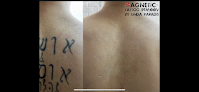 Goawaytats Tattoo Removal Laser Tattoo Removal