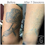 Gotham Tattoo Removal Laser Tattoo Removal