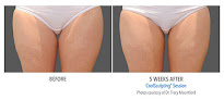 Healing Springs Medical Spa And Mountain State Cosmetic Laser Tattoo Removal