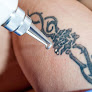 Holistic Health And Laser Hair Removal Center Laser Tattoo Removal